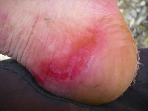 Chris\'s rubbed raw heal - fun times.